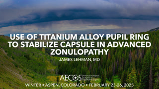 Use of titanium alloy pupil ring to stabilize capsule in advanced zonulopathy